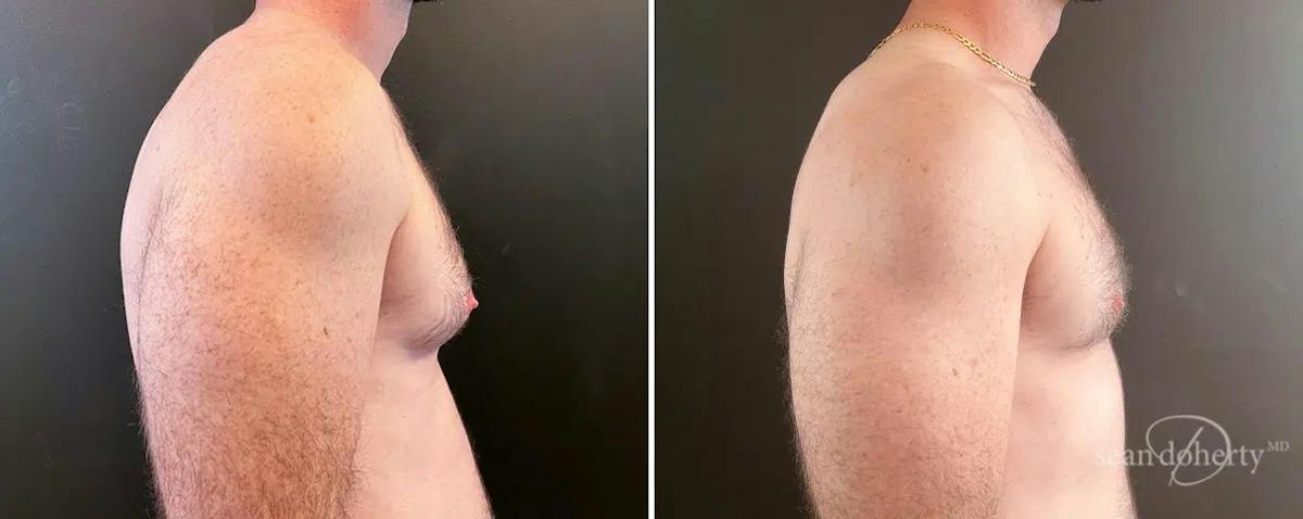 Male Breast Reduction (Gynecomastia) Before & After Gallery - Patient 149162 - Image 3