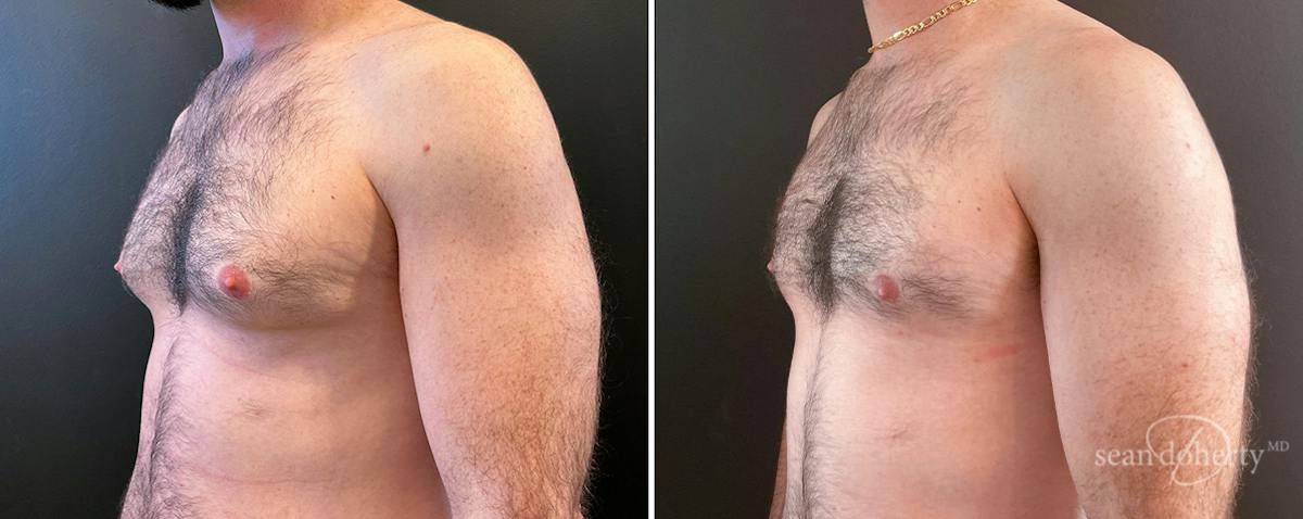 Male Breast Reduction (Gynecomastia) Before & After Gallery - Patient 149162 - Image 2