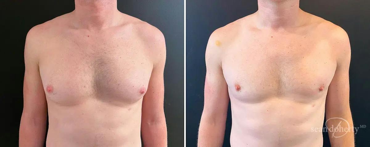 Male Breast Reduction (Gynecomastia) Before & After Gallery - Patient 295007 - Image 1