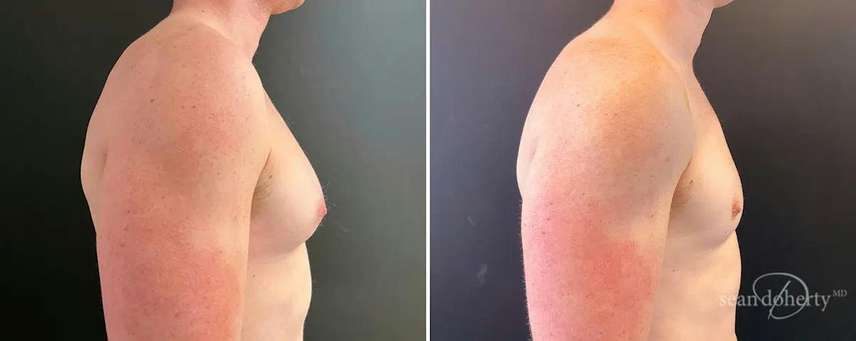 Male Breast Reduction (Gynecomastia) Before & After Gallery - Patient 295007 - Image 3