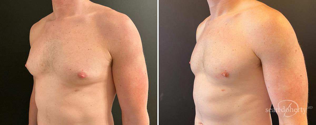 Male Breast Reduction (Gynecomastia) Before & After Gallery - Patient 295007 - Image 2