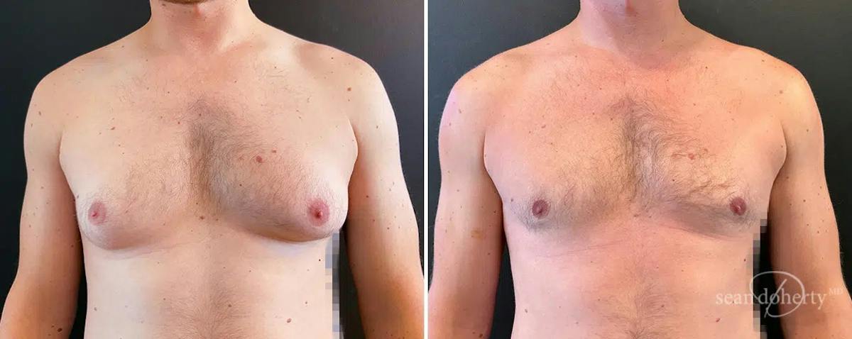 Male Breast Reduction (Gynecomastia) Before & After Gallery - Patient 105264 - Image 1