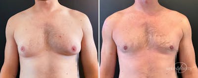 Male Breast Reduction (Gynecomastia) Before & After Gallery - Patient 105264 - Image 1