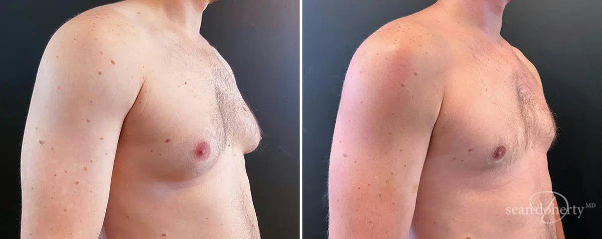 Male Breast Reduction (Gynecomastia) Before & After Gallery - Patient 105264 - Image 2