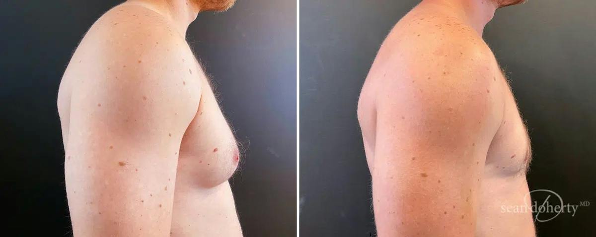 Male Breast Reduction (Gynecomastia) Before & After Gallery - Patient 105264 - Image 3