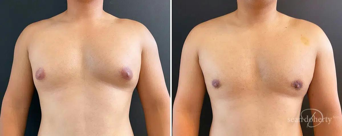 Male Breast Reduction (Gynecomastia) Before & After Gallery - Patient 297251 - Image 1