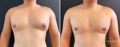 Male Breast Reduction (Gynecomastia) Before & After Gallery - Patient 297251 - Image 1