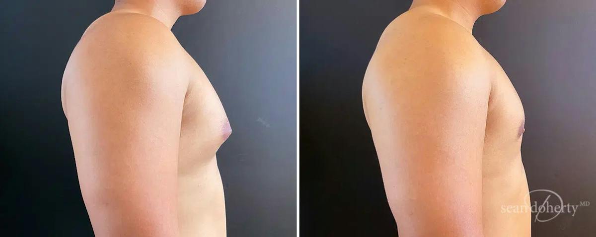 Male Breast Reduction (Gynecomastia) Before & After Gallery - Patient 297251 - Image 3