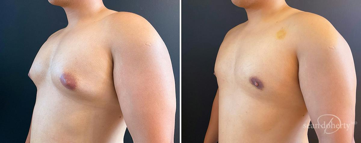 Male Breast Reduction (Gynecomastia) Before & After Gallery - Patient 297251 - Image 2