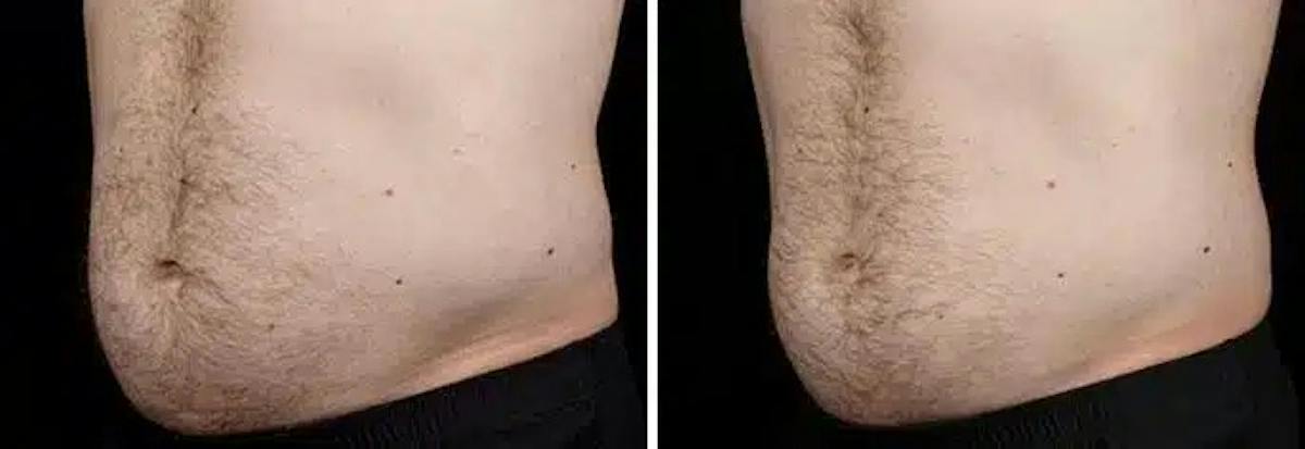 Male Coolsculpting Before & After Gallery - Patient 246903 - Image 1