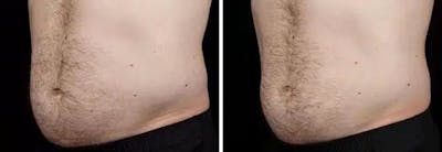 Male Coolsculpting Before & After Gallery - Patient 246903 - Image 1