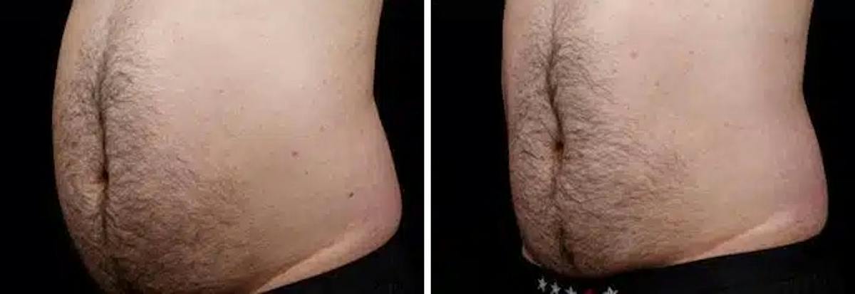Male Coolsculpting Before & After Gallery - Patient 425477 - Image 1