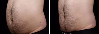 Male Coolsculpting Before & After Gallery - Patient 425477 - Image 1