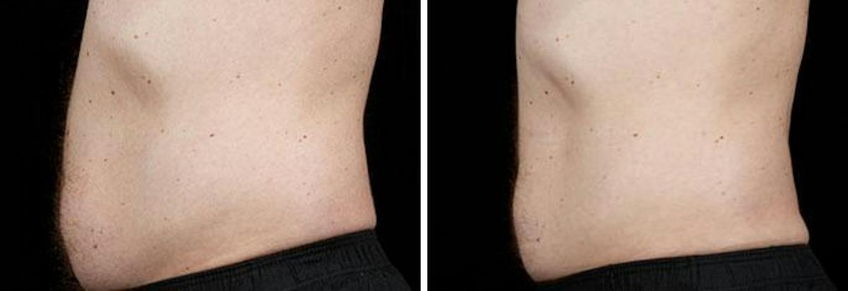 Male Coolsculpting Before & After Gallery - Patient 229224 - Image 1