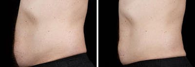 Male Coolsculpting Before & After Gallery - Patient 229224 - Image 1