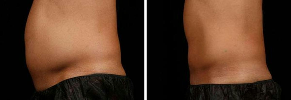 Male Coolsculpting Before & After Gallery - Patient 394925 - Image 1