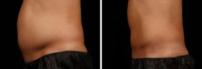 Male Coolsculpting Before & After Gallery - Patient 394925 - Image 1