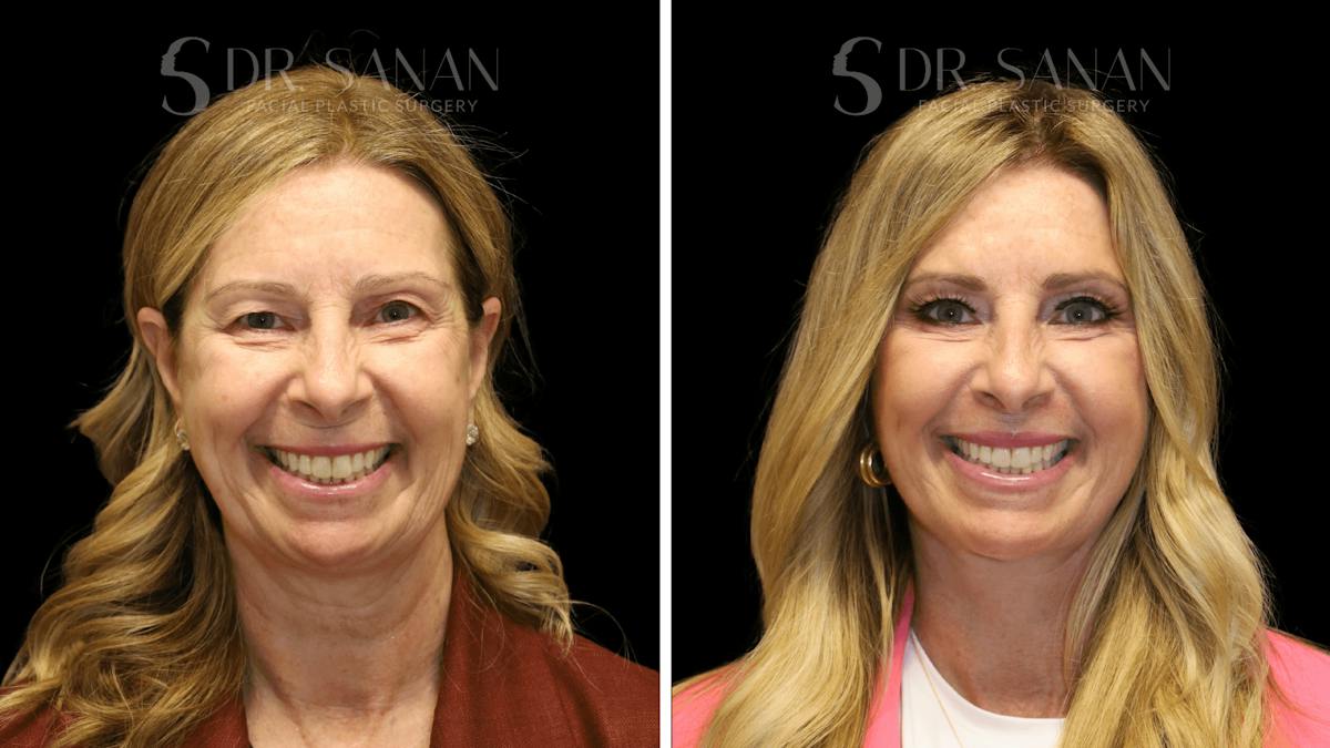 Brow Lift Before & After Gallery - Patient 132530 - Image 2