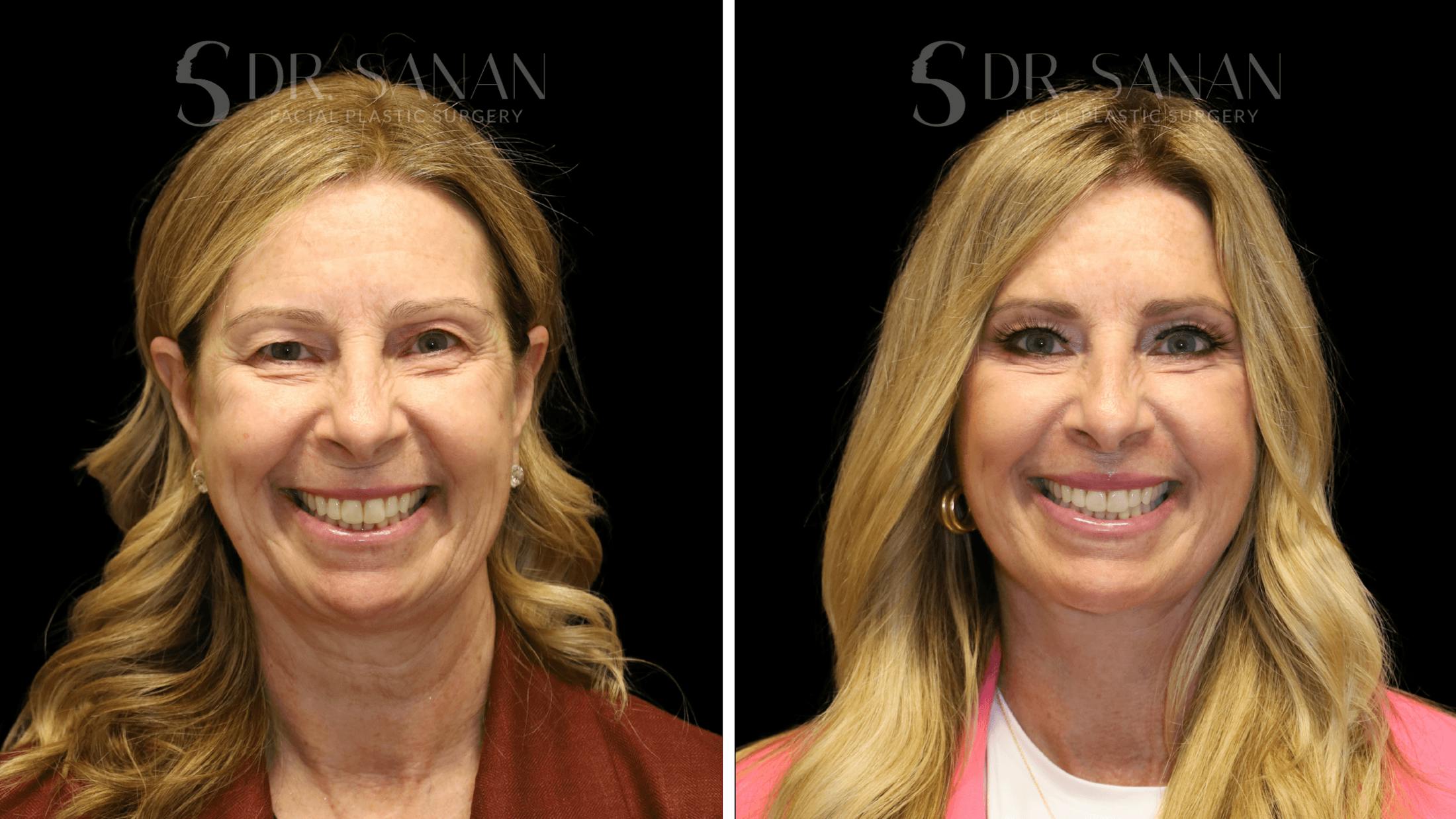 Fat Grafting Before & After Gallery - Patient 490729 - Image 7