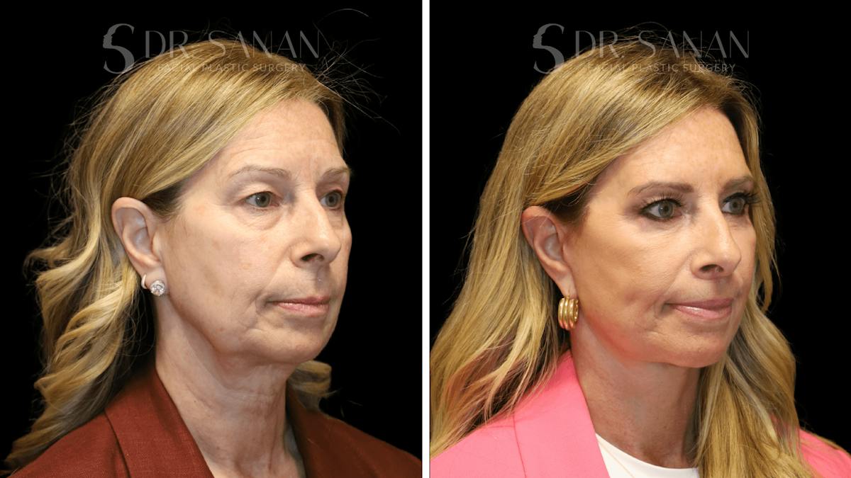 Deep Plane Facelift Before & After Gallery - Patient 207843 - Image 2