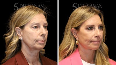 Fat Grafting Before & After Gallery - Patient 490729 - Image 1