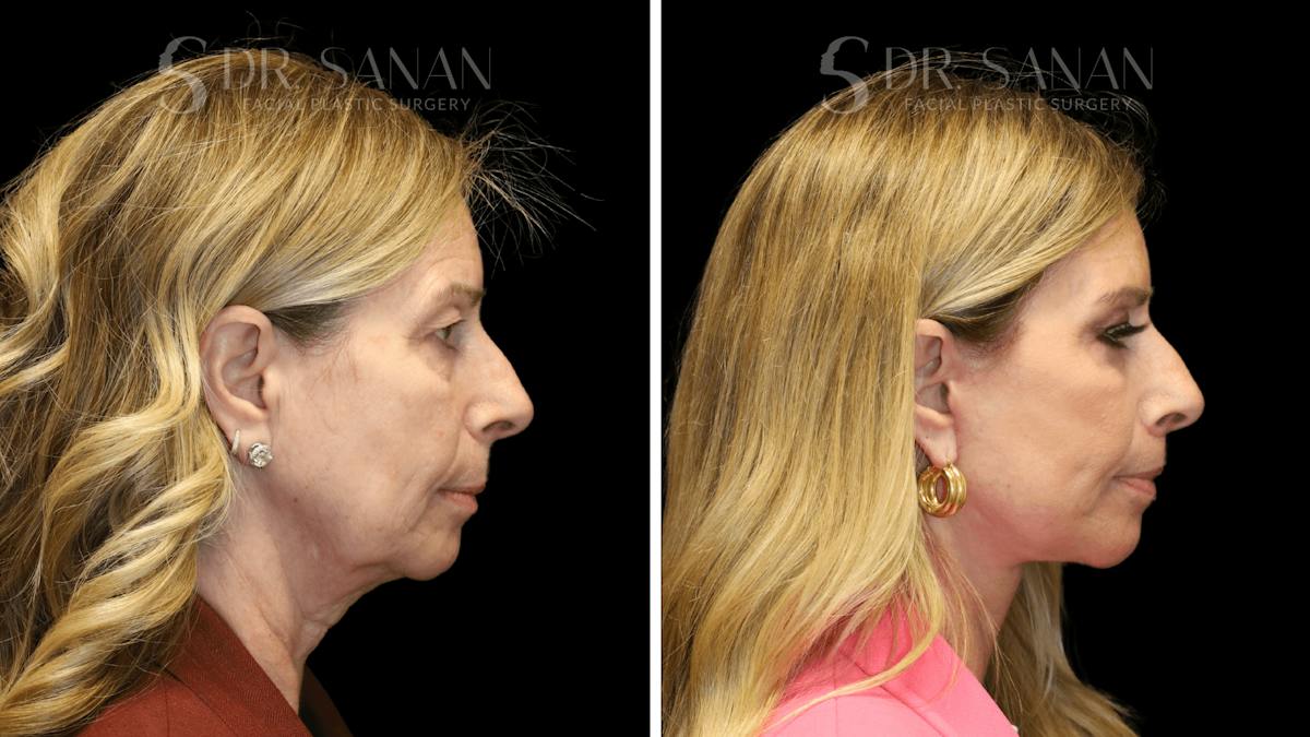 Deep Plane Facelift Before & After Gallery - Patient 207843 - Image 4