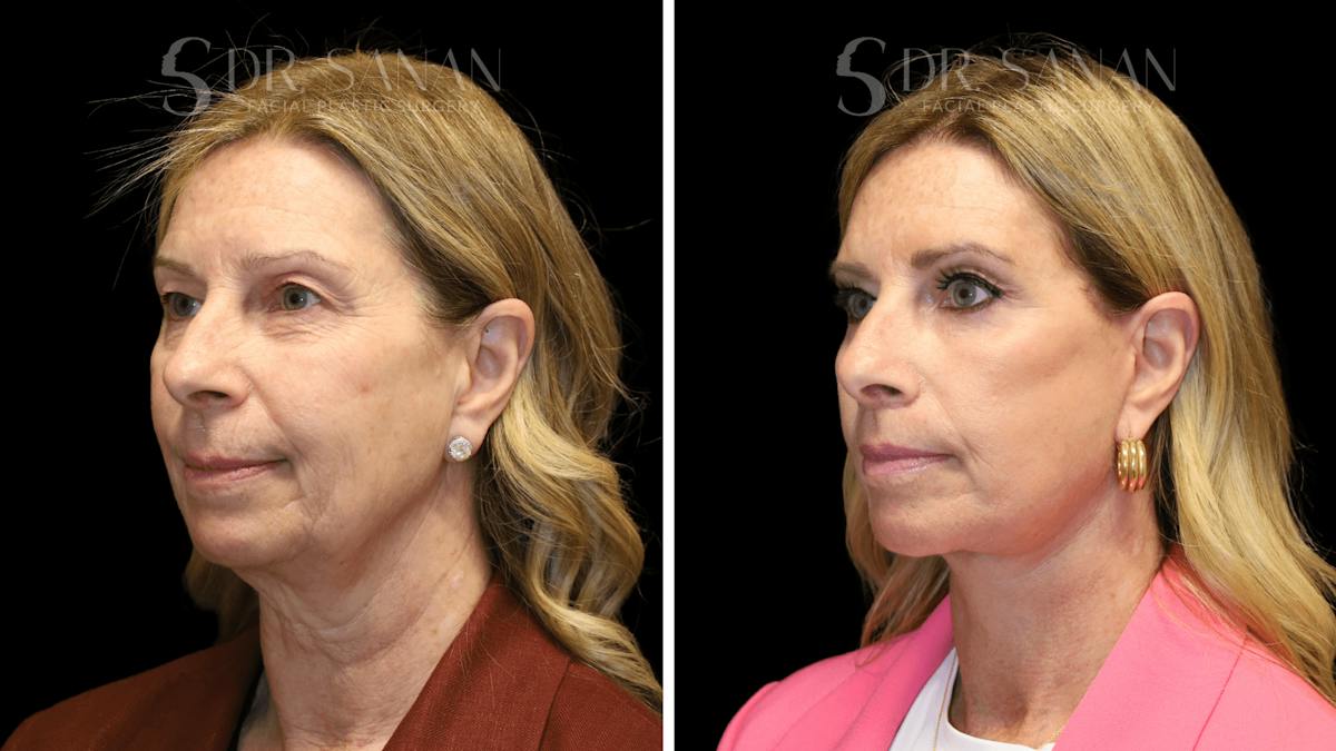 Deep Plane Facelift Before & After Gallery - Patient 207843 - Image 1