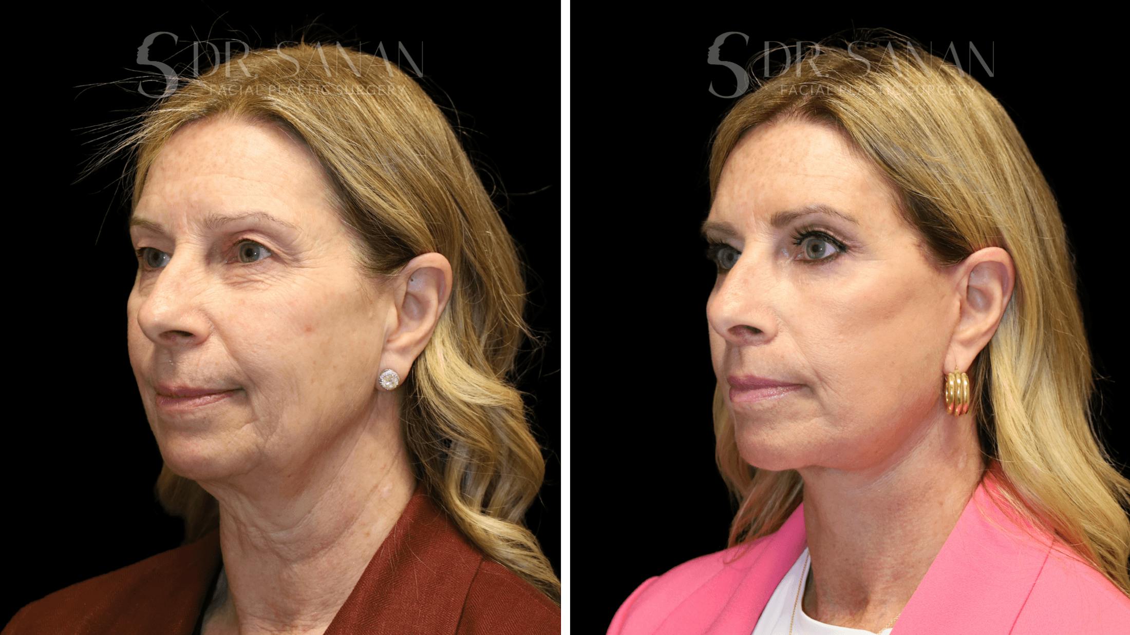 Fat Grafting Before & After Gallery - Patient 490729 - Image 2