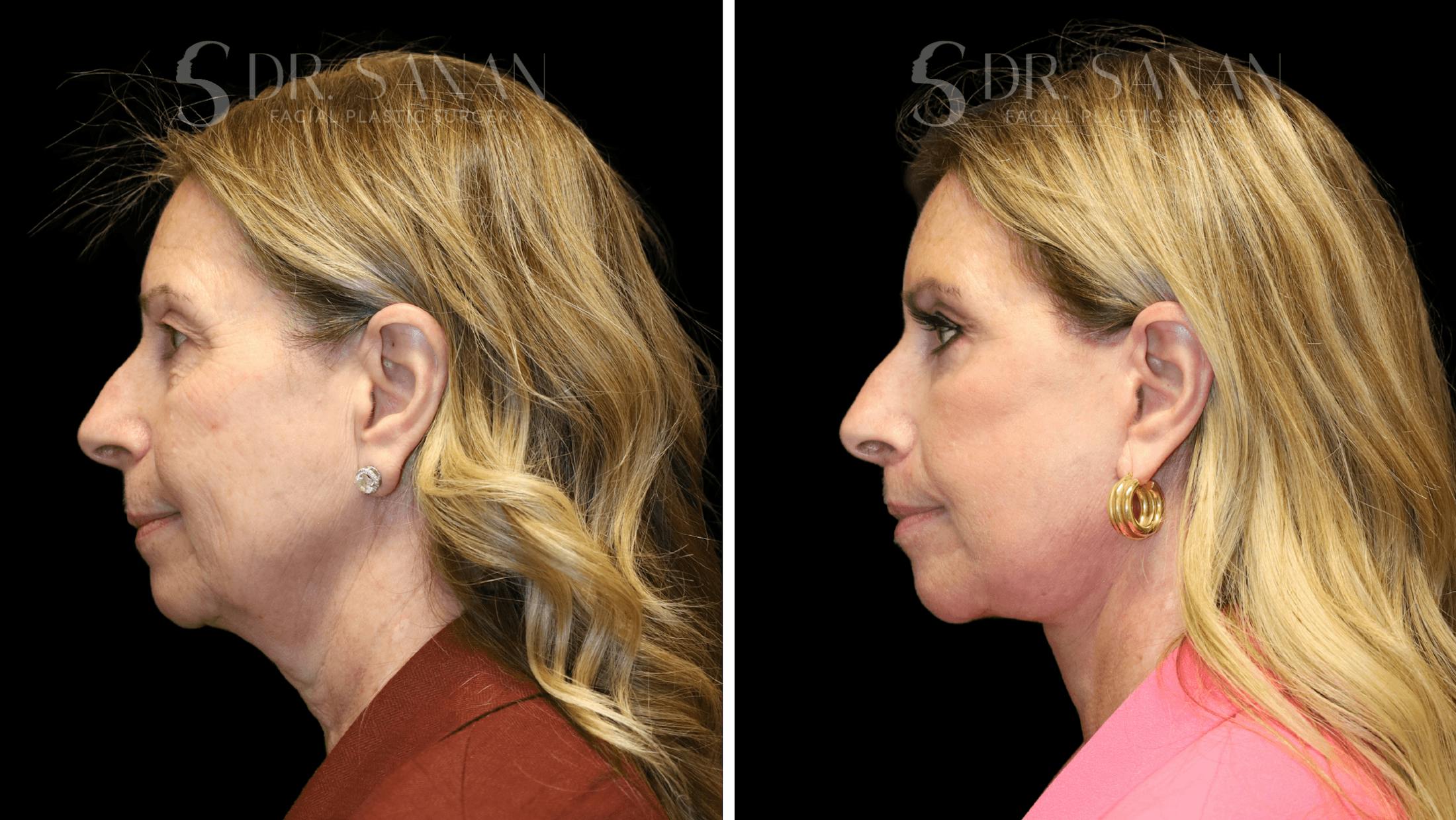Fat Grafting Before & After Gallery - Patient 490729 - Image 3