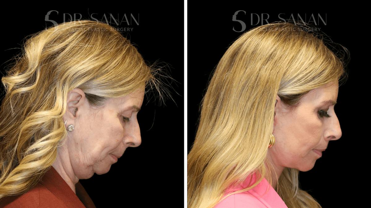 Deep Plane Facelift Before & After Gallery - Patient 207843 - Image 6