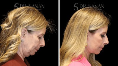 Neck Lift Before & After Gallery - Patient 124770 - Image 1