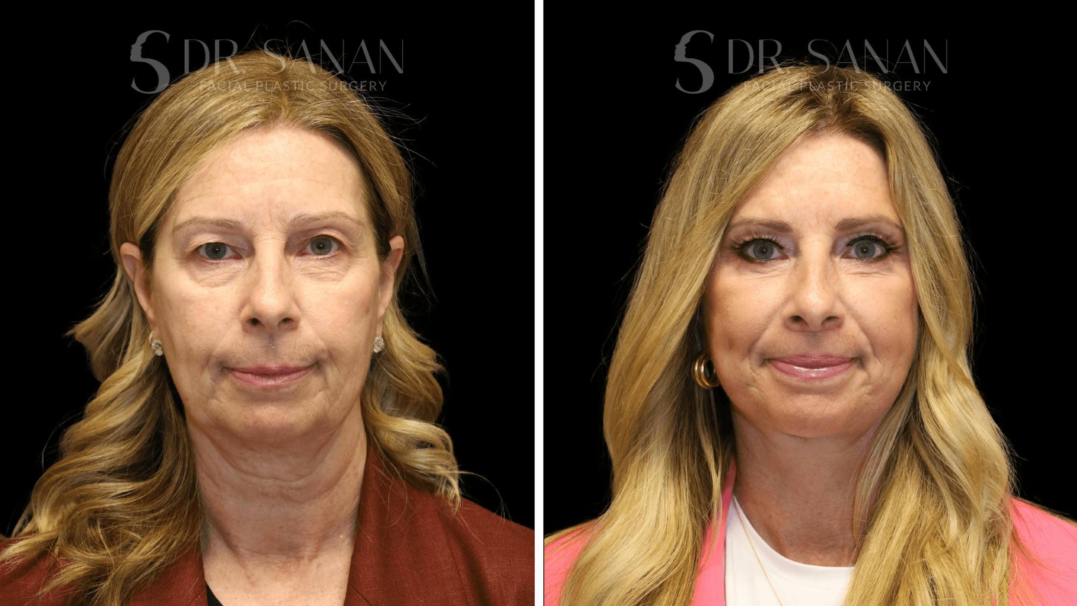 Fat Grafting Before & After Gallery - Patient 490729 - Image 8