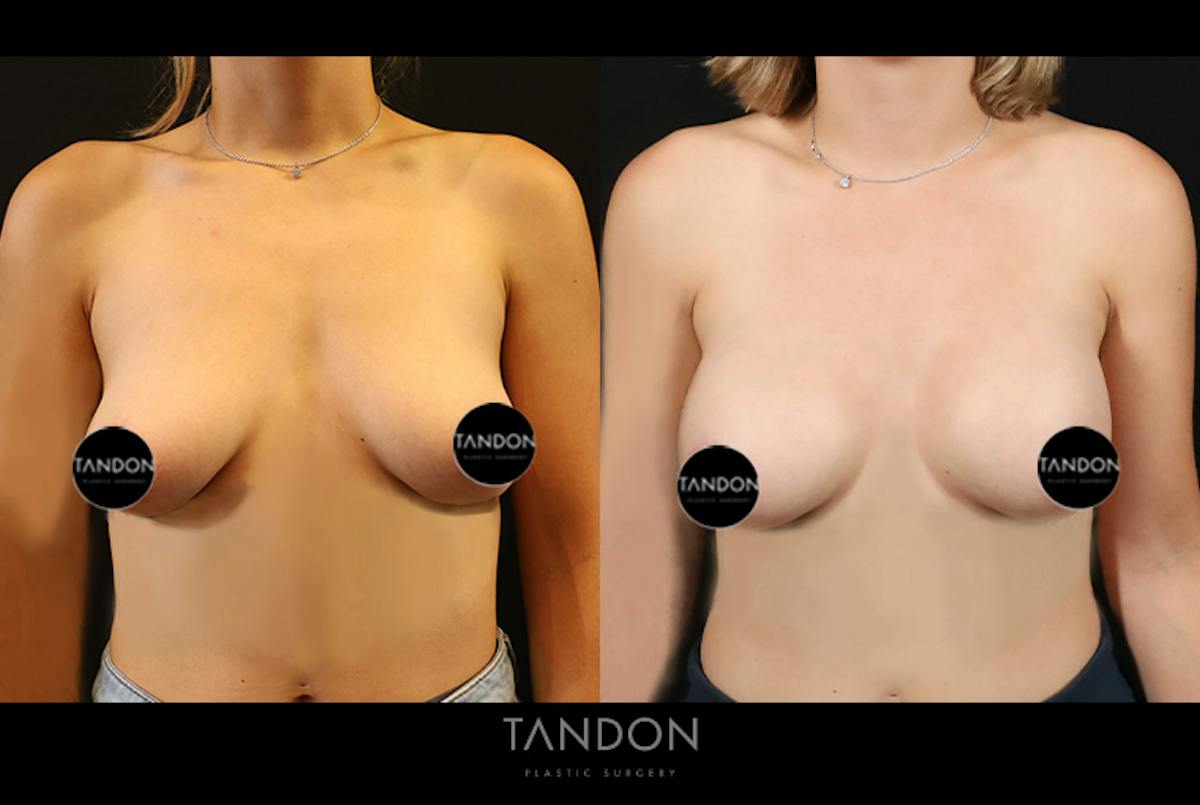 Preservé by Motiva Breast Augmentation Before & After Gallery - Patient 383032 - Image 1