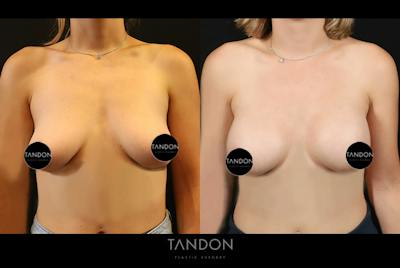 Preservé by Motiva Breast Augmentation Before & After Gallery - Patient 383032 - Image 1