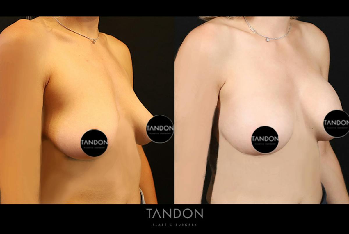 Preservé by Motiva Breast Augmentation Before & After Gallery - Patient 383032 - Image 2