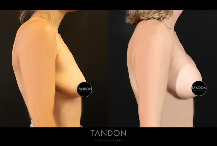 Preservé by Motiva Breast Augmentation Before & After Gallery - Patient 383032 - Image 3