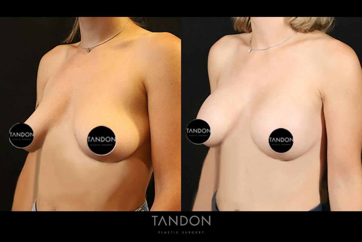 Preservé by Motiva Breast Augmentation Before & After Gallery - Patient 383032 - Image 4