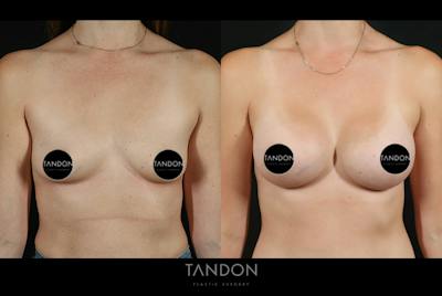 Breast Augmentation Before & After Gallery - Patient 101140 - Image 1