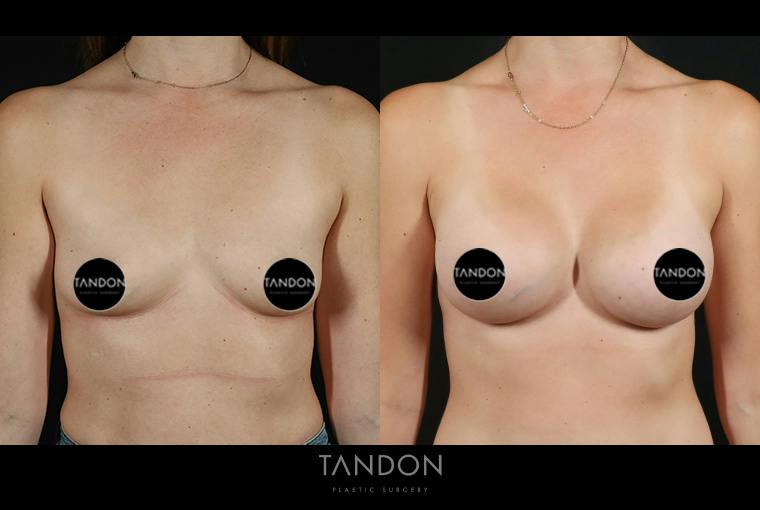 Breast Augmentation Before & After Gallery - Patient 101140 - Image 1