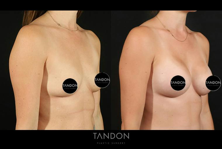 Breast Augmentation Before & After Gallery - Patient 101140 - Image 2
