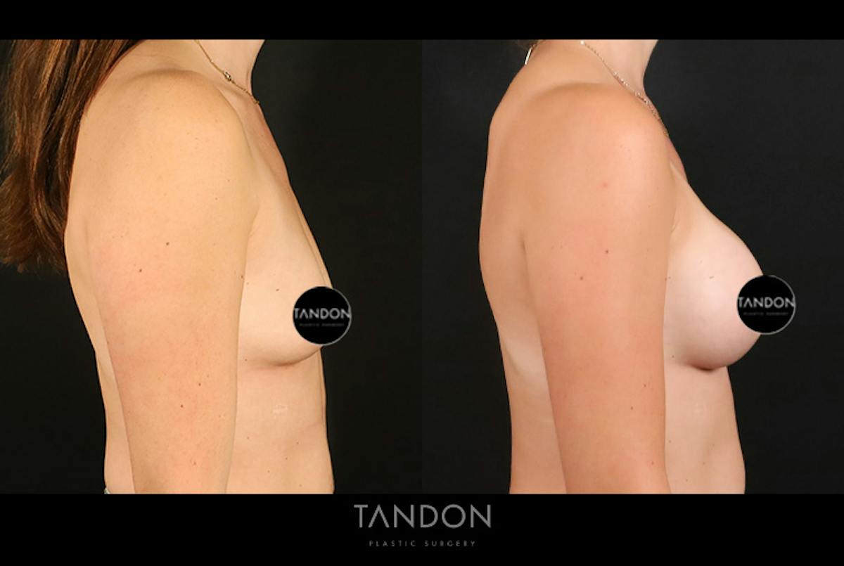 Breast Augmentation Before & After Gallery - Patient 101140 - Image 3