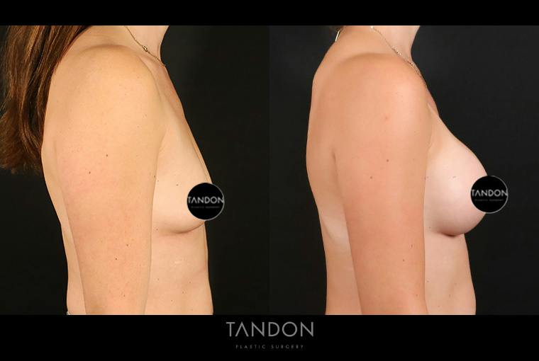 Breast Augmentation Before & After Gallery - Patient 101140 - Image 3
