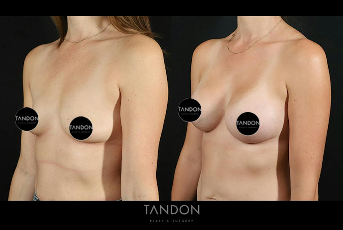 Breast Augmentation Before & After Gallery - Patient 101140 - Image 4