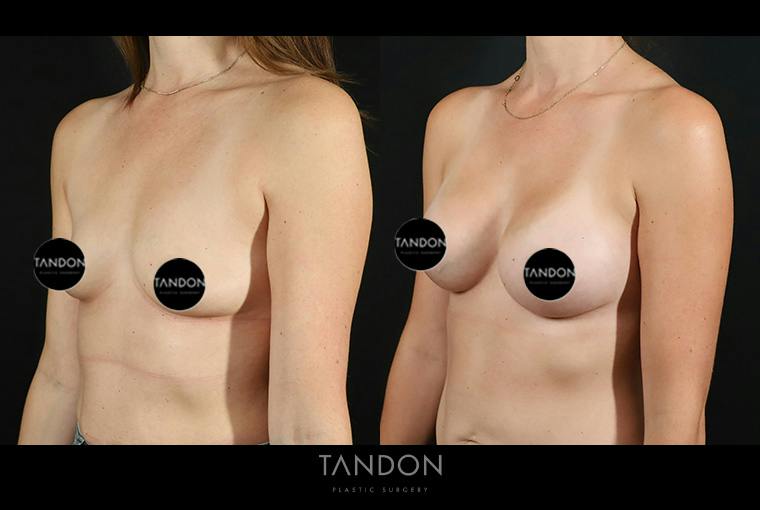 Breast Augmentation Before & After Gallery - Patient 101140 - Image 4