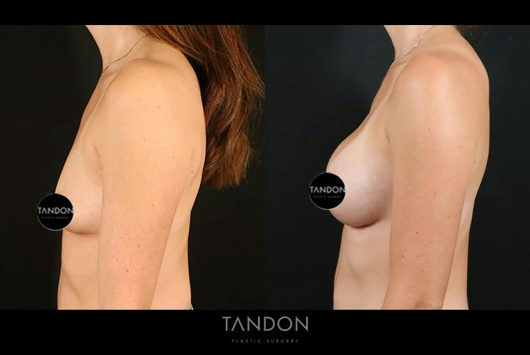 Breast Augmentation Before & After Gallery - Patient 101140 - Image 5