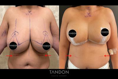 Breast Reduction Before & After Gallery - Patient 250905 - Image 1