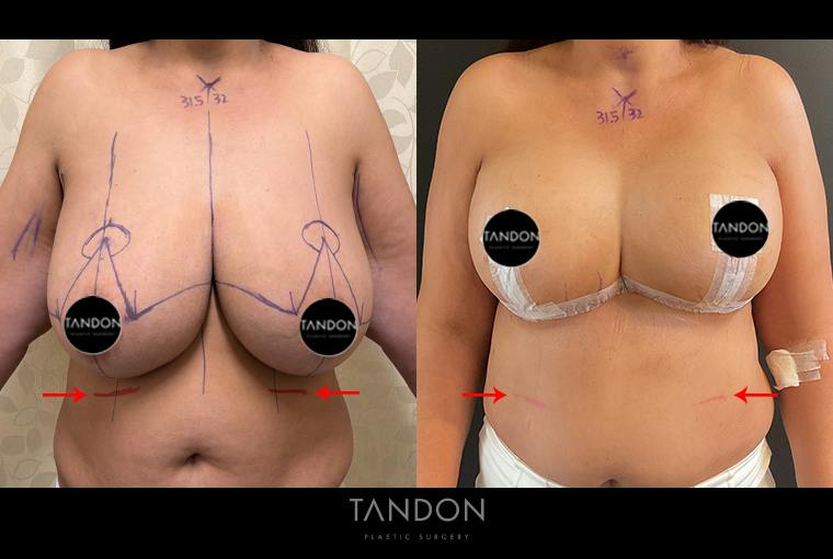 Breast Reduction Before & After Gallery - Patient 250905 - Image 1