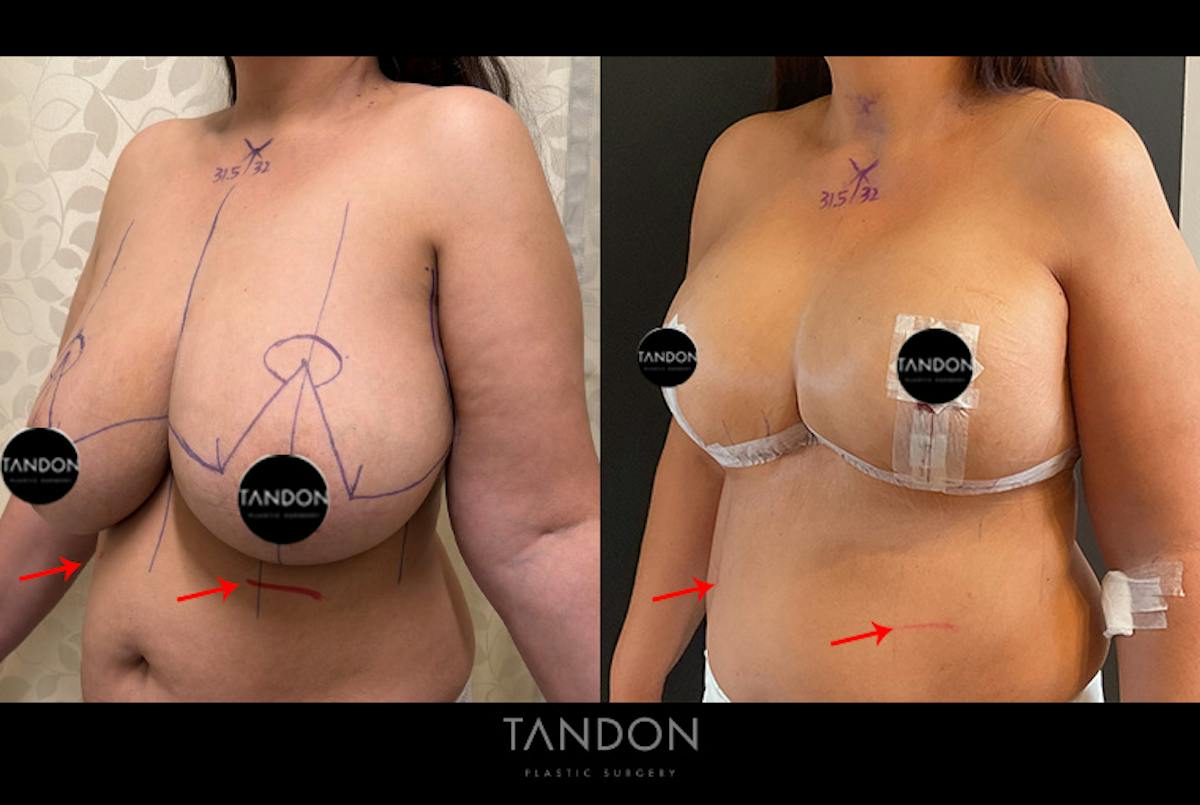 Breast Reduction Before & After Gallery - Patient 250905 - Image 3