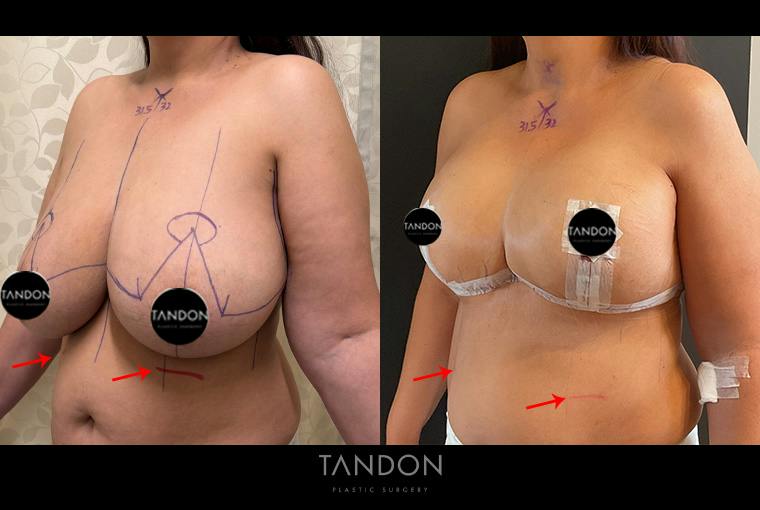 Breast Reduction Before & After Gallery - Patient 250905 - Image 3