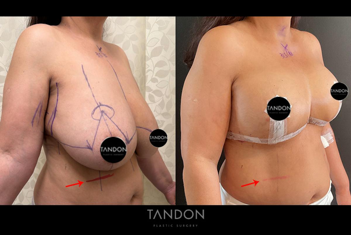 Breast Reduction Before & After Gallery - Patient 250905 - Image 2